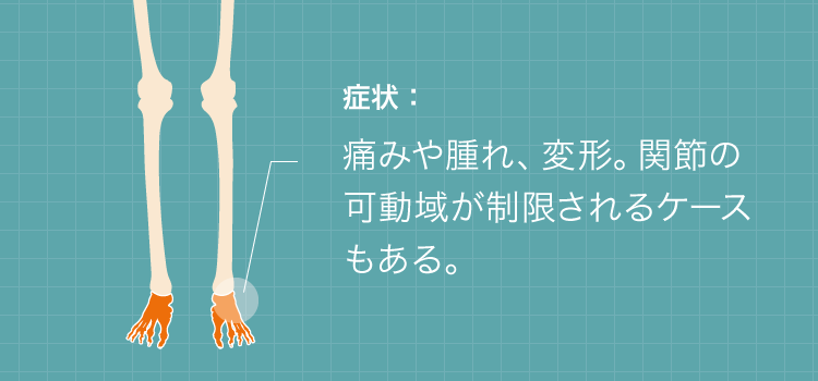 足首骨折の症状