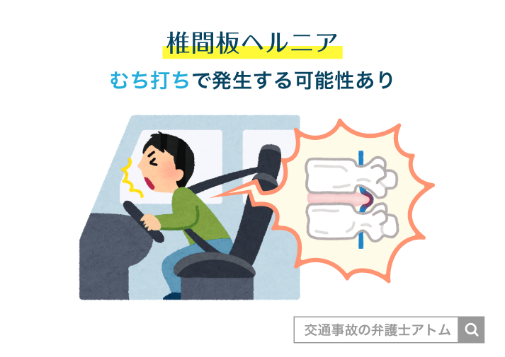 椎間板ヘルニア