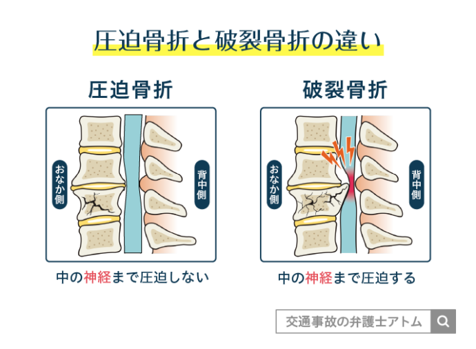 圧迫骨折と破裂骨折の違い