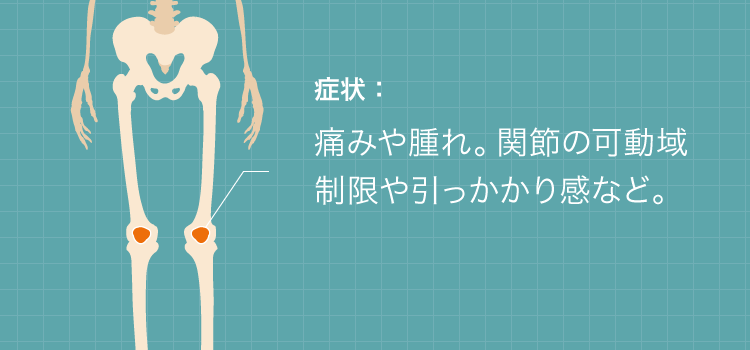 半月板損傷の症状:痛みや腫れ。関節の可動域制限や引っかかり感など。
