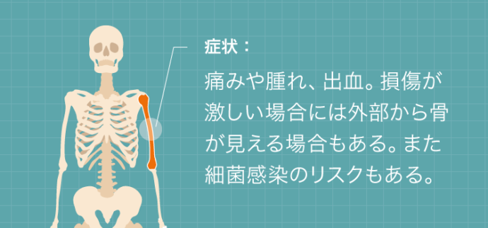 開放骨折の症状：痛みや腫れ、出血。損傷が激しい場合には外部から骨が見える場合もある。また、細菌感染のリスクもある。