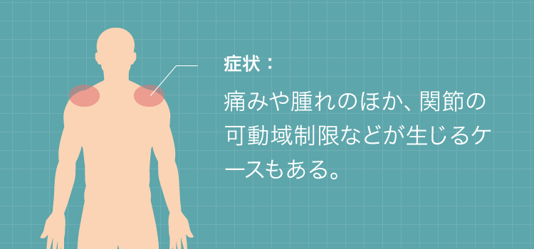 肩腱板の構造と損傷箇所を示す解剖図