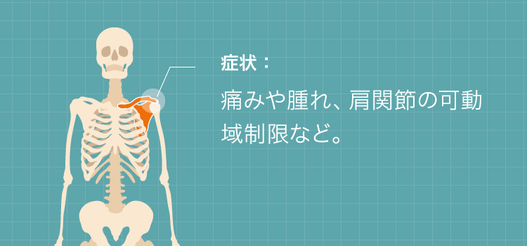 肩鎖関節脱臼の症状