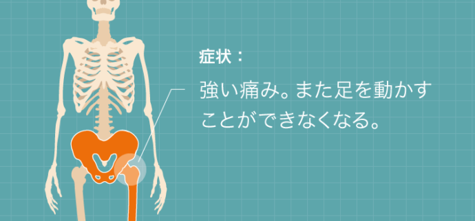 股関節脱臼の症状：強い痛み。また足を動かすことができなくなる。