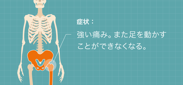 股関節脱臼の症状：強い痛み。また足を動かすことができなくなる。