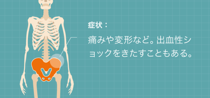 骨盤骨折の症状：痛みや変形など。出血性ショックをきたすこともある。