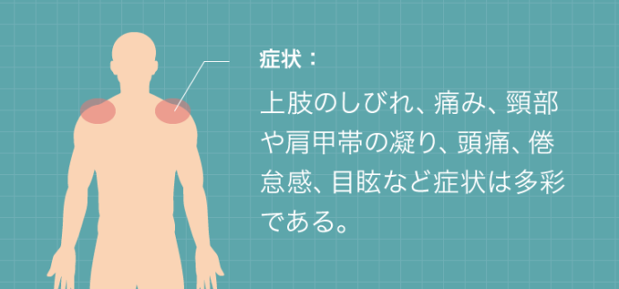 胸郭出口症候群の症状