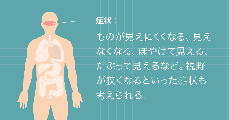 視覚障害の症状:ものが見えにくくなる、見えなくなる、ぼやけて見える、だぶって見えるなど。視野が狭くなるといった症状も考えられる。
