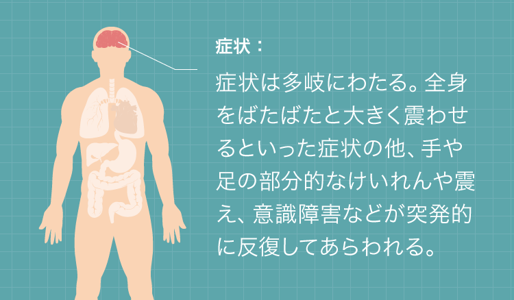 てんかんの症状：症状は多岐にわたる。全身をばたばたと大きく震わせるといった症状の他、手や足の部分的なけいれんや震え、意識障害などが突発的に反復してあらわれる。