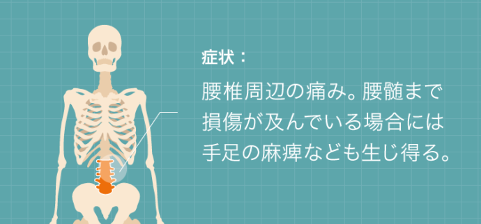 腰椎捻挫の症状：腰椎周辺の痛み。腰髄まで損傷が及んでいる場合には手足の麻痺なども生じ得る。