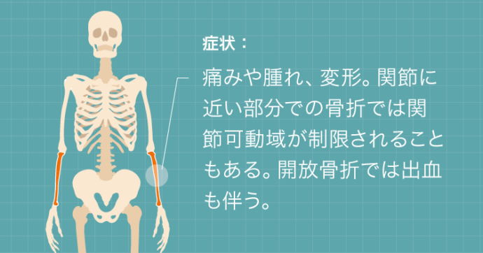 症状：痛みや腫れ、変形。関節に近い部分での骨折では関節可動域が制限されることもある。@橈骨遠位端骨折の後遺症